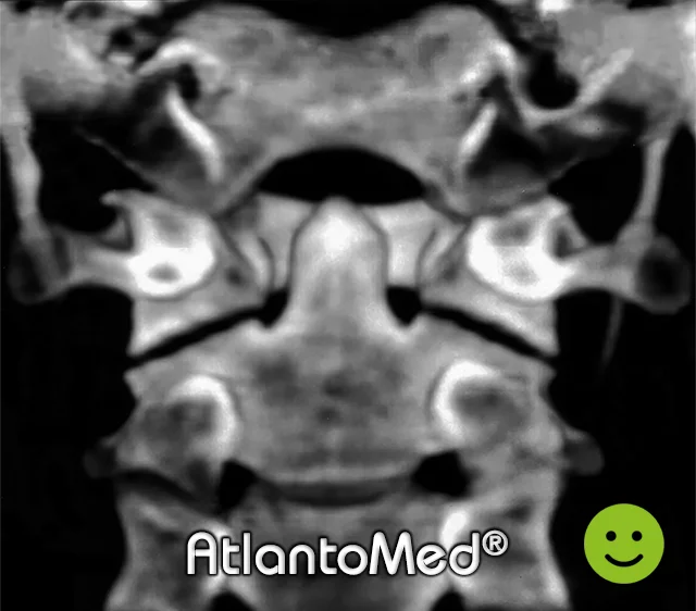 CT spiral of Atlas and Axis before and after Atlas alignment