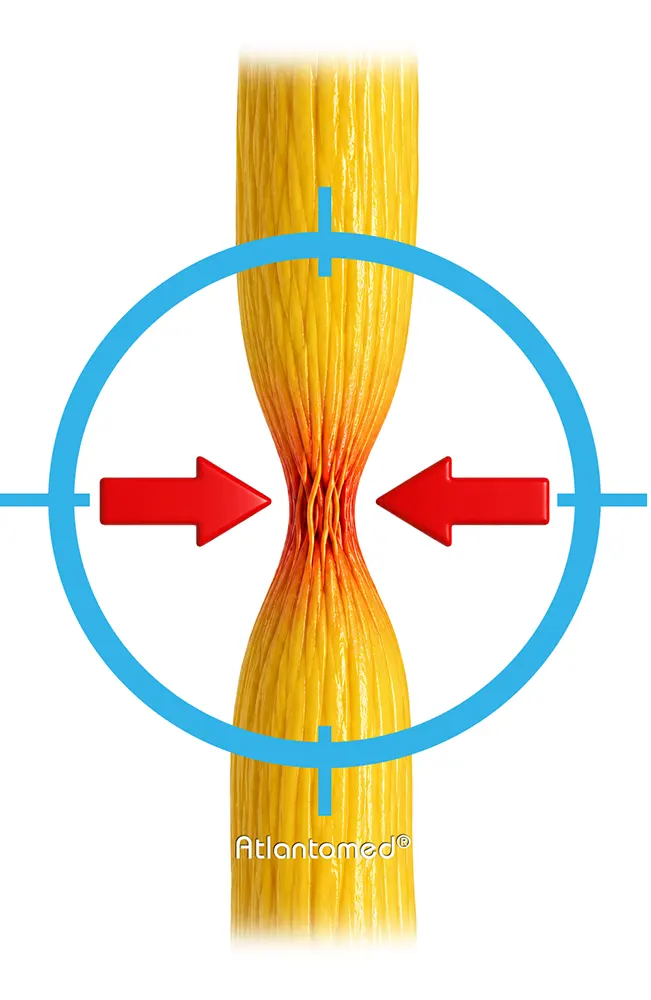 vagus nerve compression
