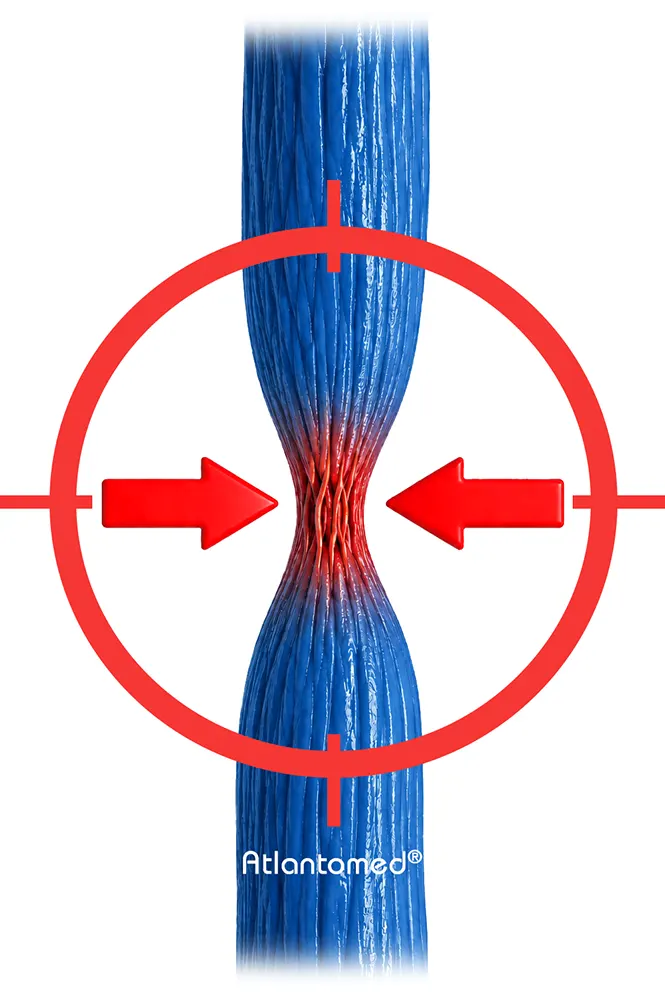 vessel narrowing and its effect on the circulatory system vessel narrowing and its effect on the circulatory system