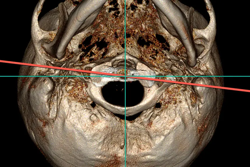 Computed Tomography of the Atlas vertebra