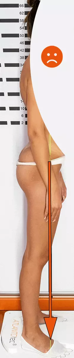 Hallux valgus posture before and after