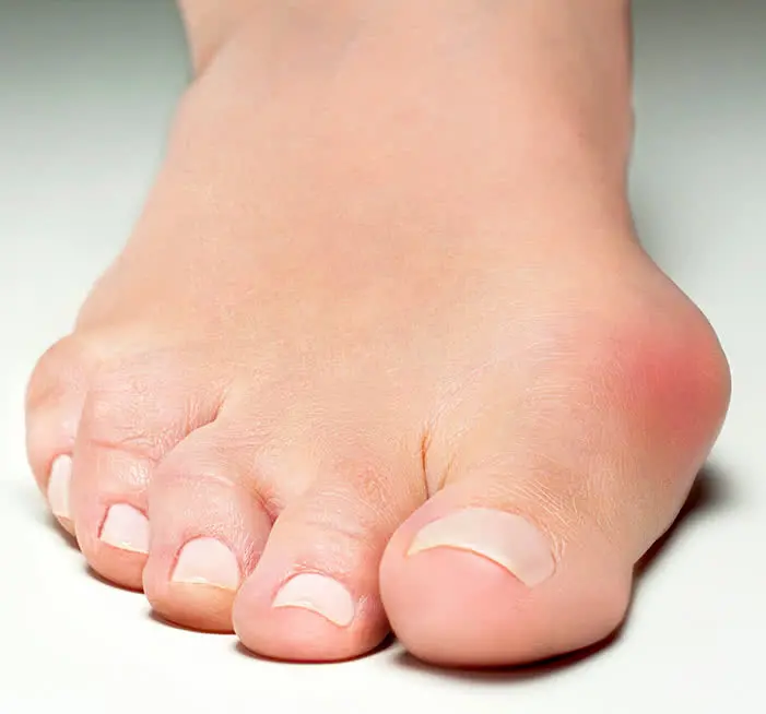 Solution for hallux valgus