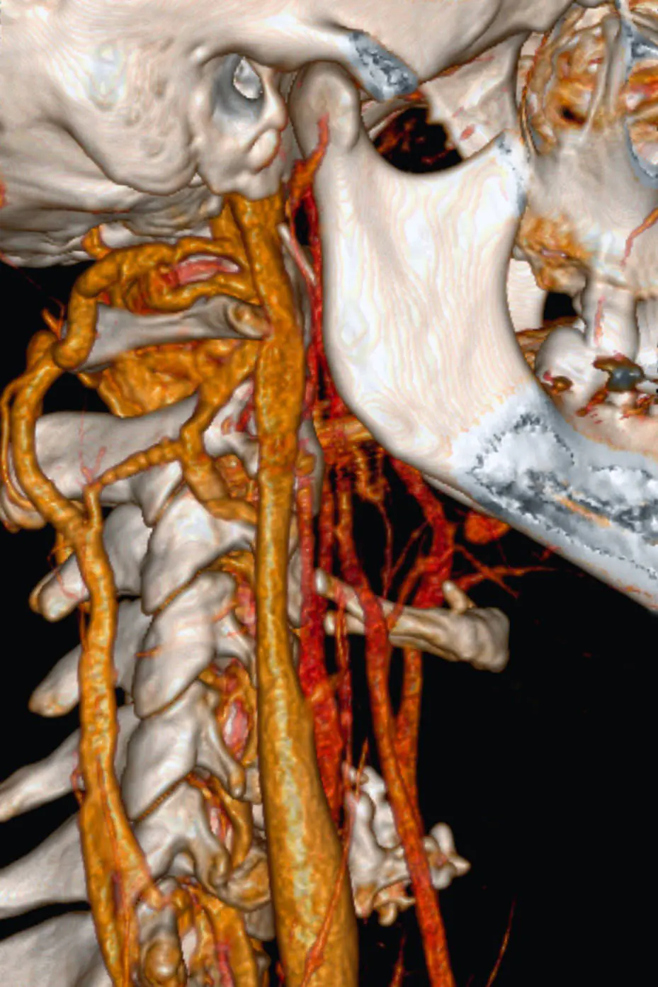 CT cervical angiography