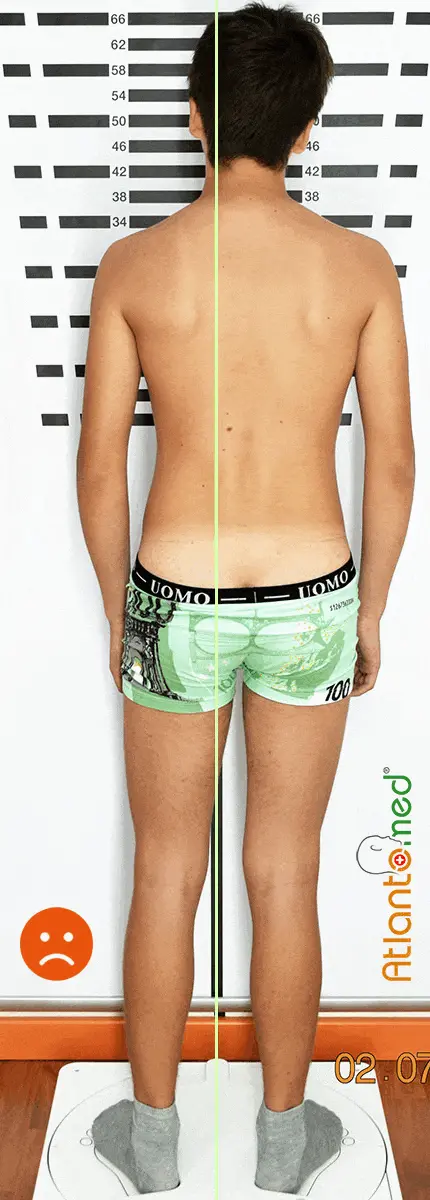 Pelvic tilt - asymmetry / pelvic obliquity