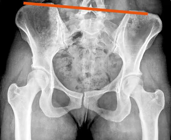 X-ray of tilted pelvis