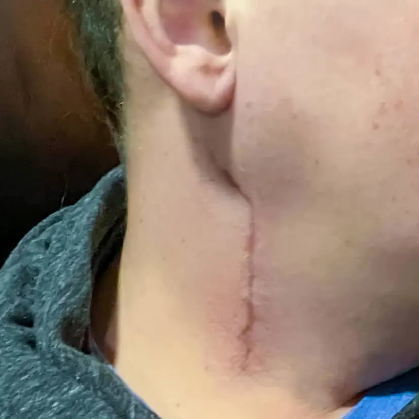 Surgery and cervical spine straightening