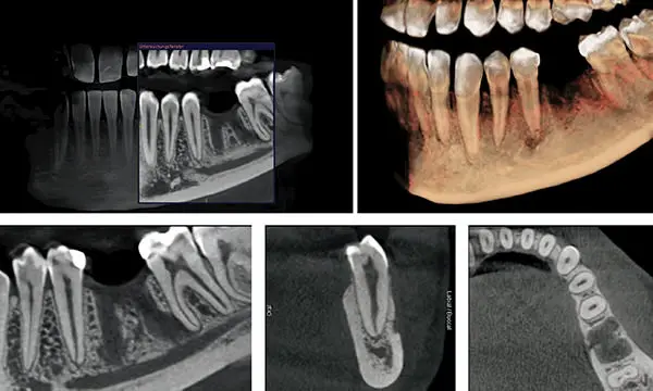 Cone Beam of the jaw to detect hidden infections Cone Beam of the jaw