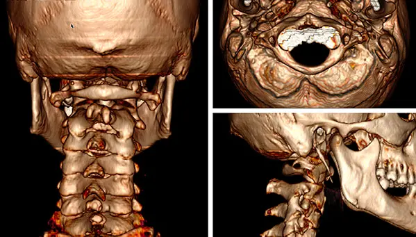 Cervical CT scan to view the Atlas vertebra Cervical CT scan