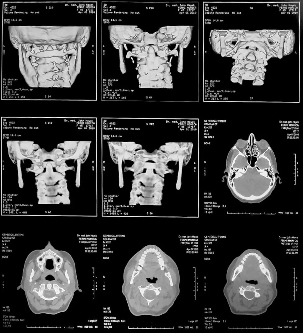 Spiral CT / Tomography of the Skull and Atlas Vertebra