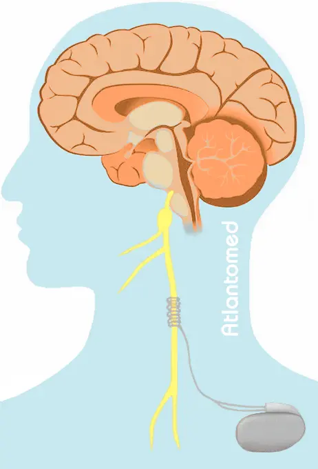 Vagus nerve and epileptic attacks