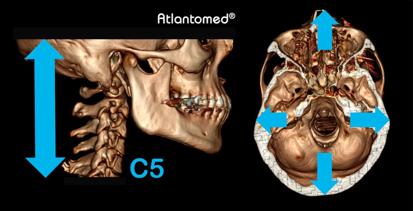 Spiral CT of the skull and cervical with Atlas and Axis