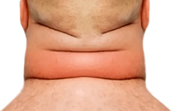 Bull neck
