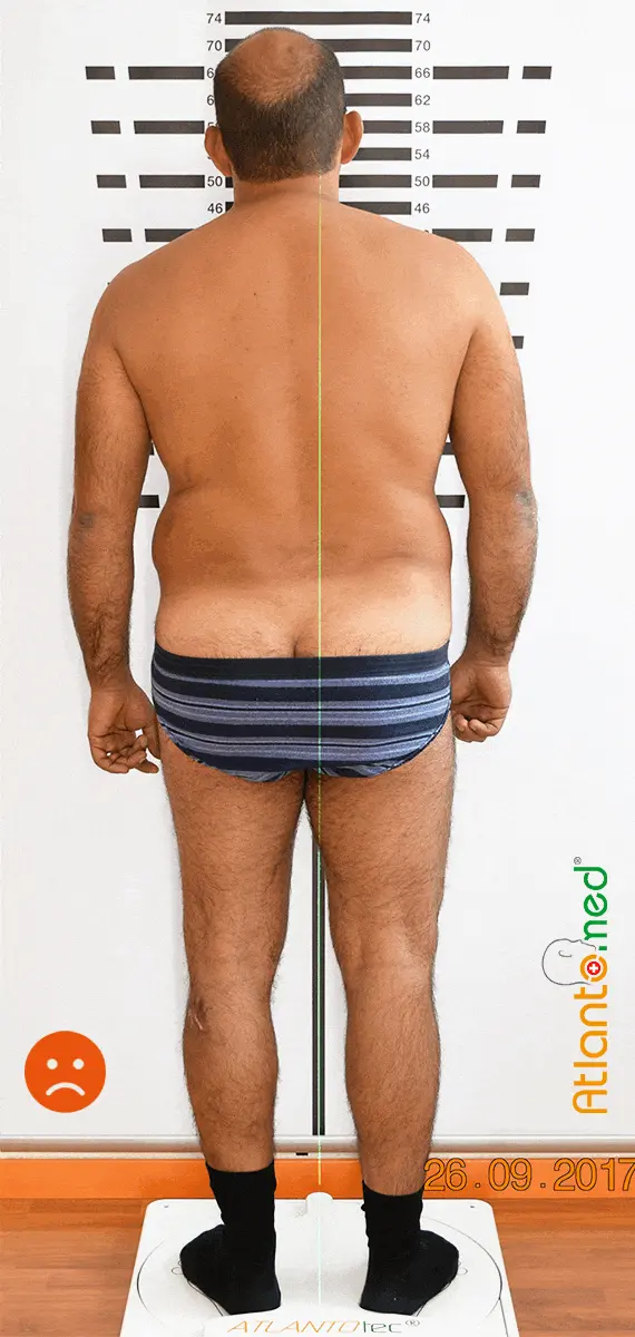 Posture improvement after Atlas correction