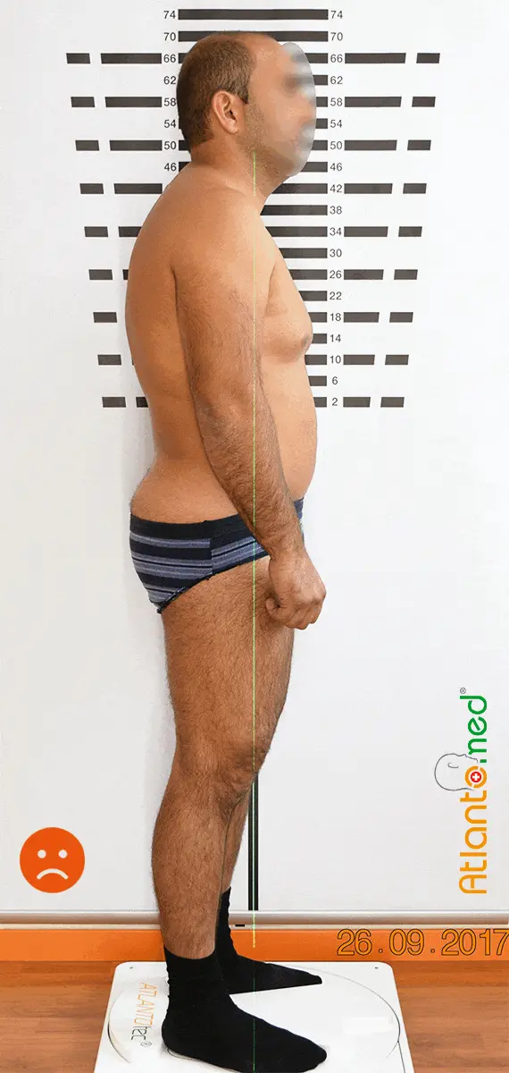 Postural change after Atlas realignment