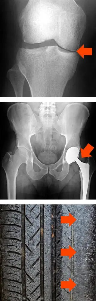 Hip and knee pain caused by degenerated joints