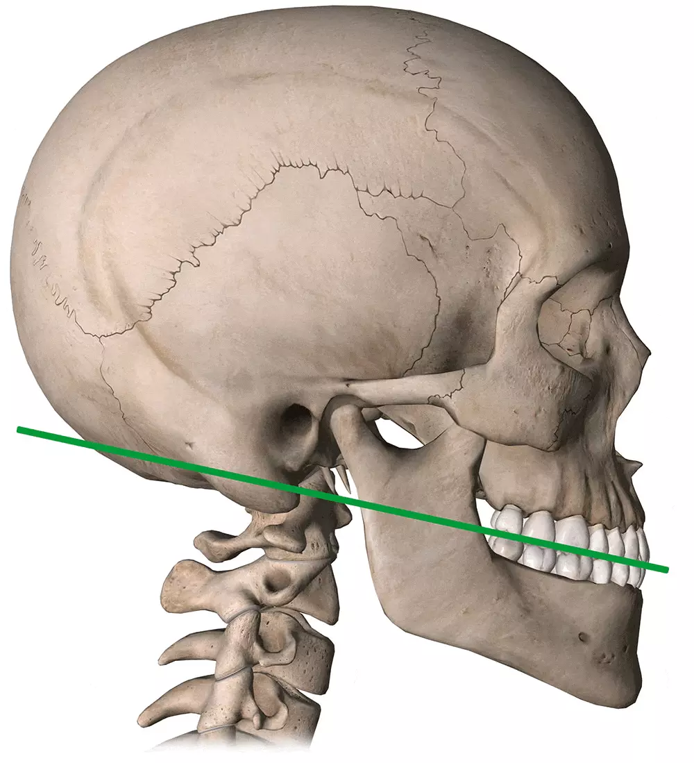 Cervical spine straightening and deviated jaw