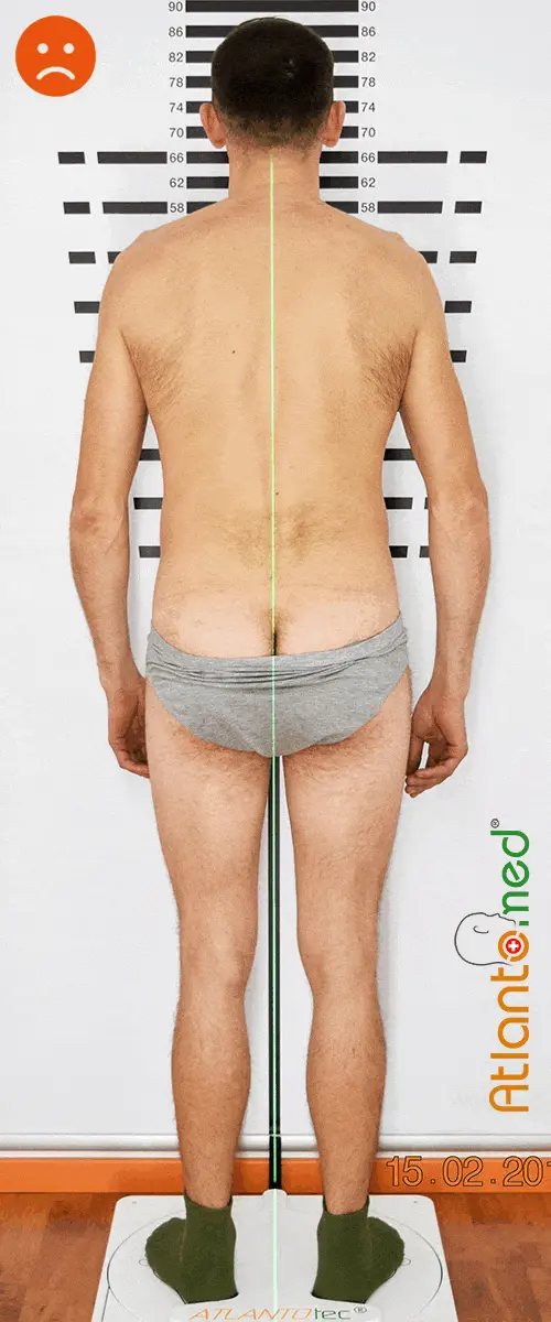 Scoliosis before and after