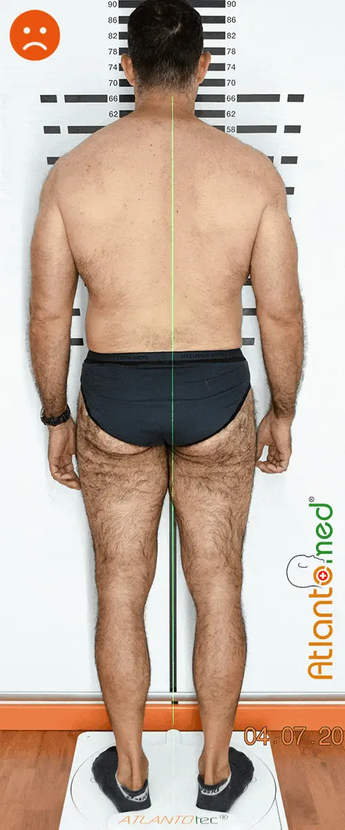 Tilted pelvis before and after