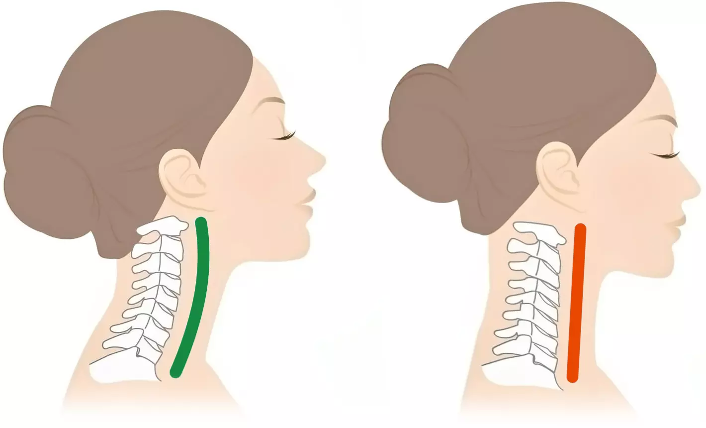 Cervical spine straightening