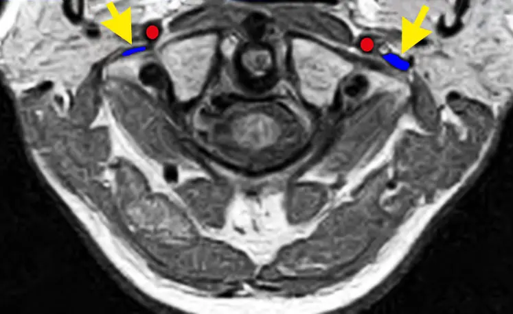MRI of the Atlas vertebra jugular vein compression MRI Atlas vertebra jugular vein compression