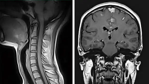Cervical magnetic resonance imaging Cervical magnetic resonance imaging