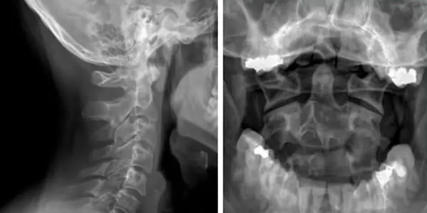 Cervical and intraoral X-ray to view the Atlas vertebra Cervical and intraoral X-ray