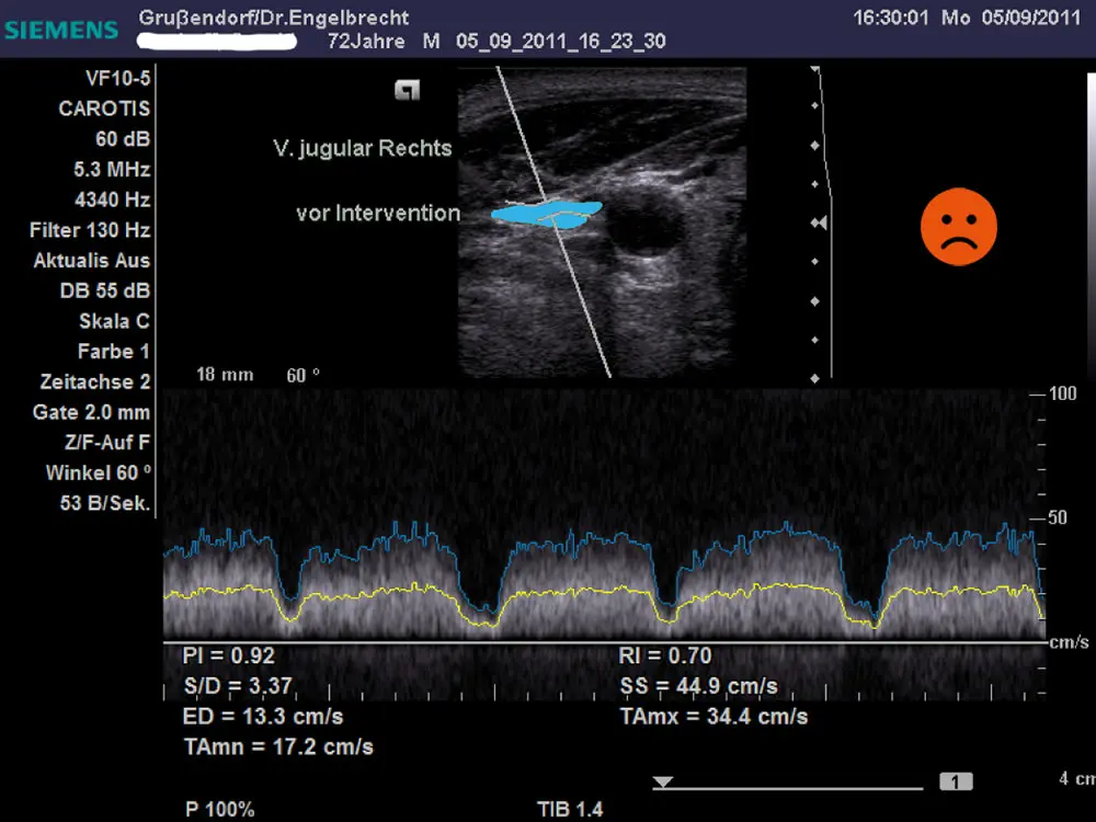 Ultrasound image of the compressed jugular vein before Atlas correction Ultrasound image of the compressed jugular vein before Atlas correction