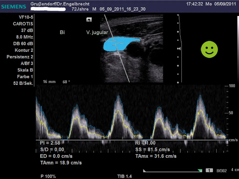 Ultrasound of the jugular vein after Atlas realignment Ultrasound of the jugular vein after Atlas realignment