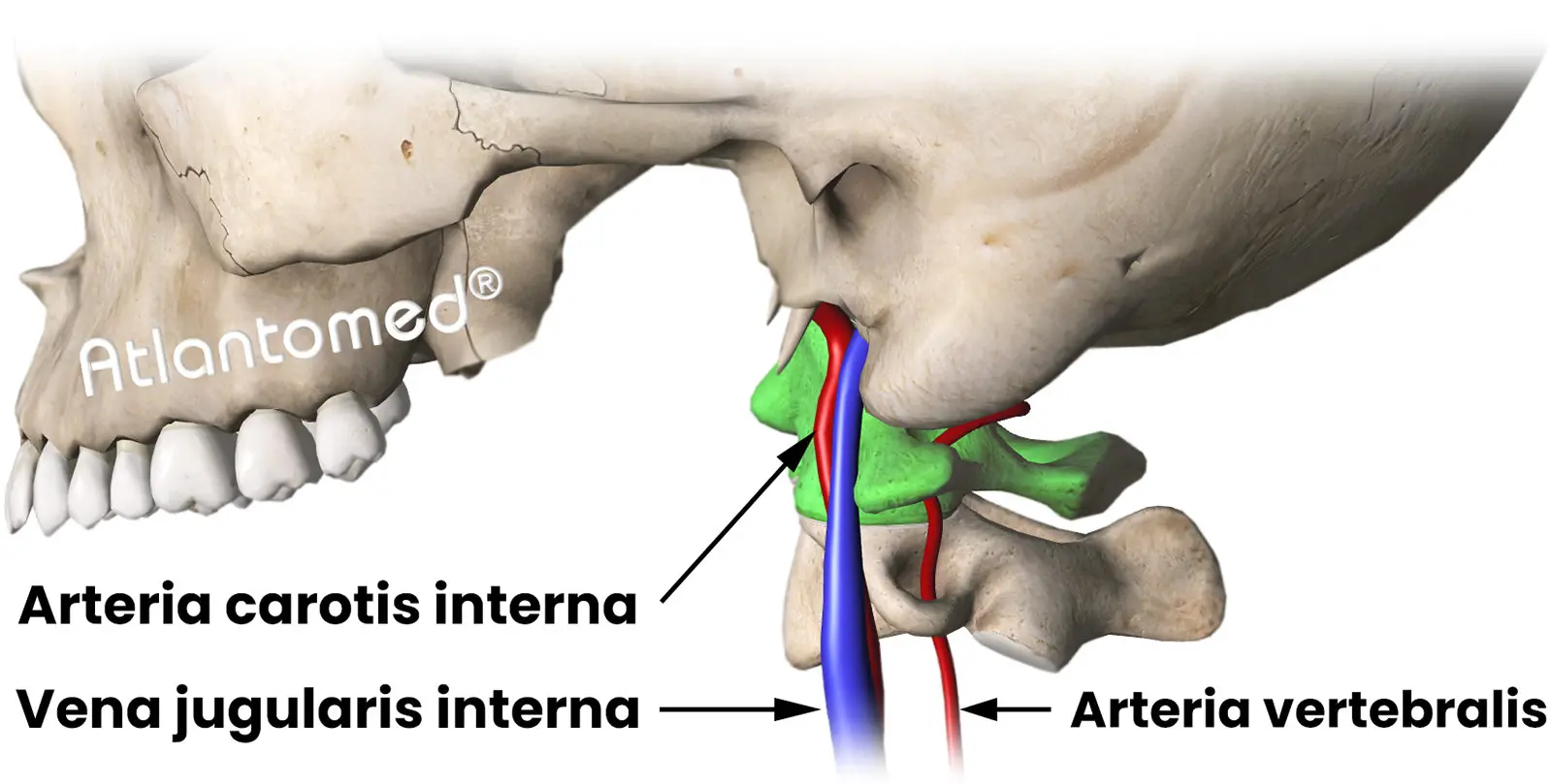 Migraine caused by vertebral artery compression due to Atlas misalignment
